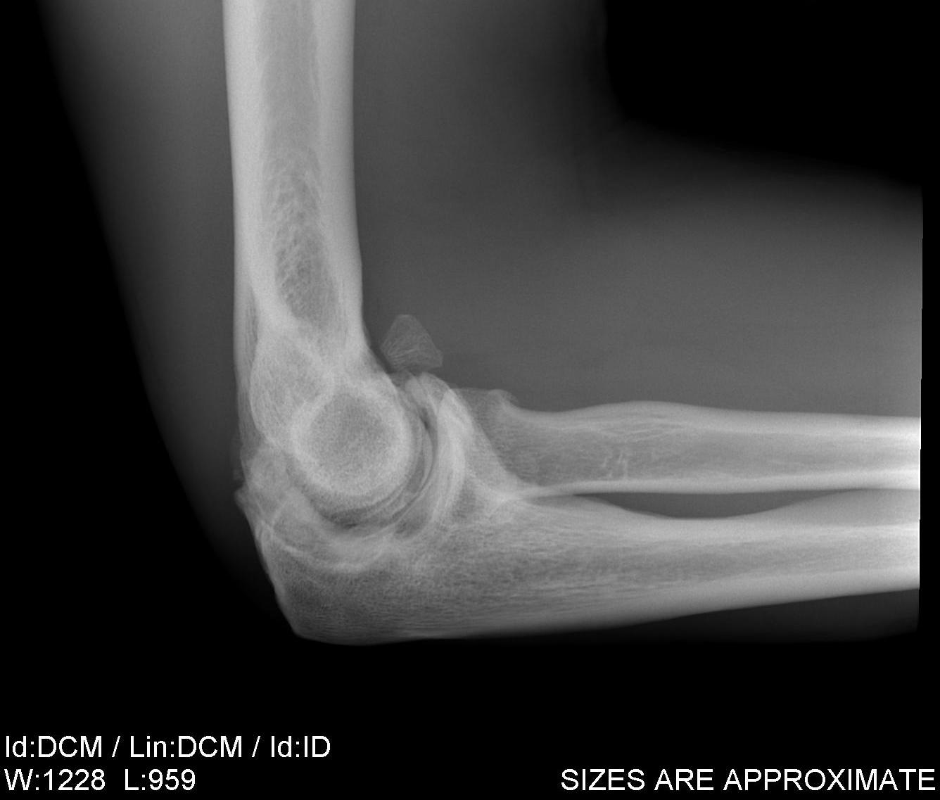 Elbow Myositis Ossificans